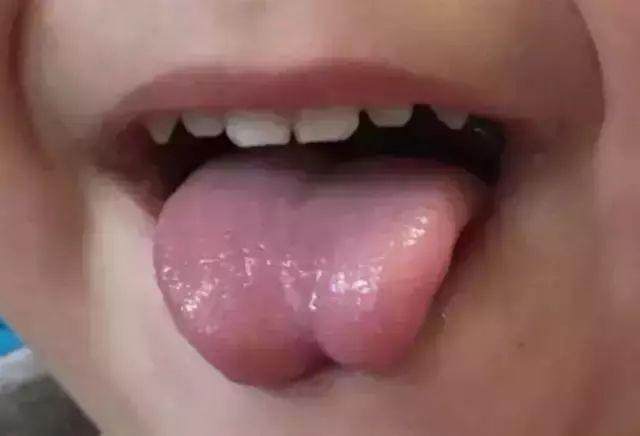 舌系带过短的危害1,影响吃奶正常母乳时,宝宝是用舌头垫在牙床上吸奶